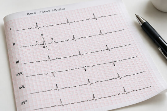 ECG printout with PQRST wave pattern on white table, medical heart health