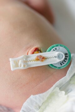 Newborn baby belly with clamped umbilical cord stump