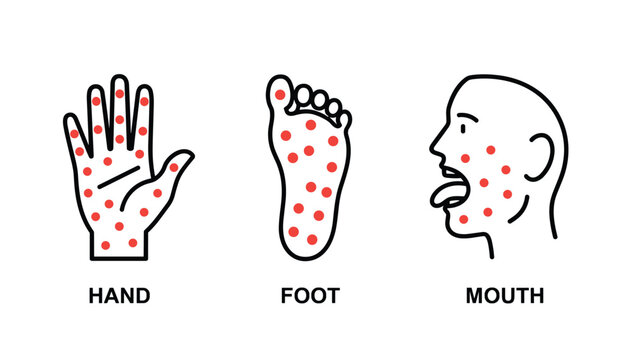 Medical illustration showing hand foot and mouth disease symptoms with prominent red spots on skin surface.