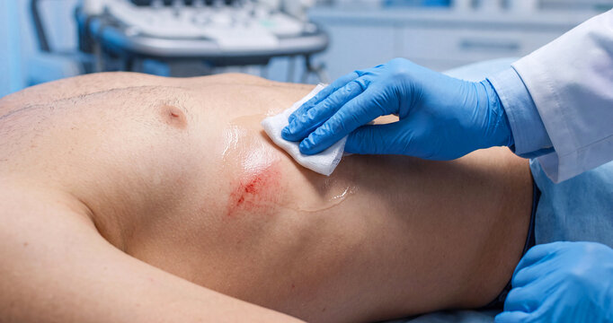 Healthcare professional cleans and treats a superficial abrasion on a male patient's chest with sterile gauze. Close-up clinical wound care and first aid concept.