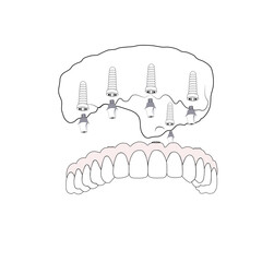 Maxillary Dental Implant Placement Anatomy Vector Illustration © EshghePichan