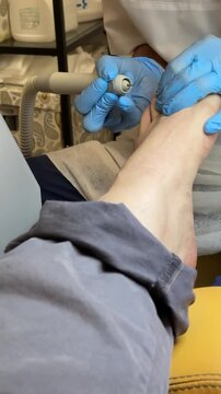 Close-up foot pedicure salon, master uses diamond drill on male foot wearing blue gloves, callus removal around heel and toes