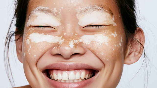 Happy female portrait showing symmetrical white pigment patches across the eyelids and upper cheeks, laughing with closed eyes, localized vitiligo, facial pigment loss, achromic pa