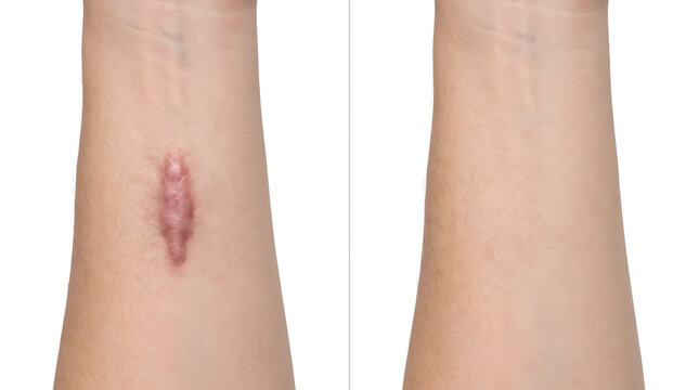 keloid scar removal before and after treatment | dermatological laser surgery for skin scars | medical procedure to reduce hypertrophic scarring | professional skin care results