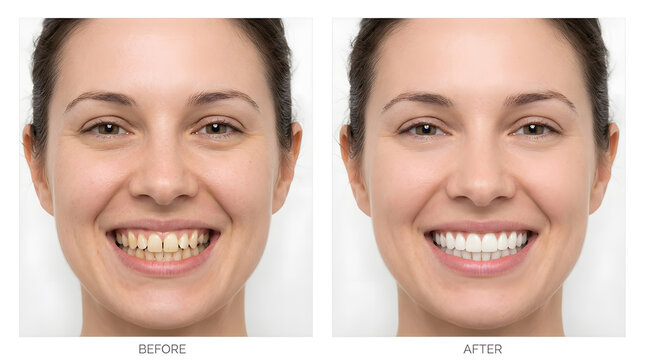 teeth whitening before and after results | dental veneers transformation for woman | professional smile makeover comparison | cosmetic dentistry before and after