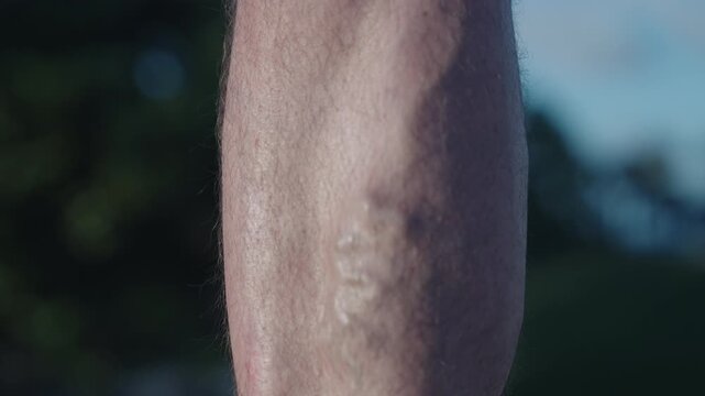 Varicosity veins on male leg. Varicose veins on legs of man footage. Varicosity spider vein disease. Male leg with varicose veins. Man suffering from varicose vein. Varicose veins on the legs of men
