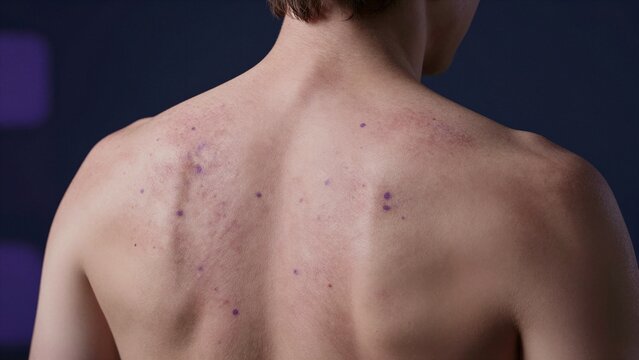 A detailed view of a person's back revealing distinct purple and red skin rash patterns against smooth skin texture.