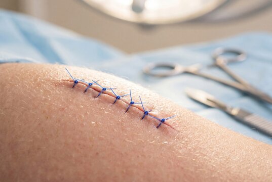 Medical Stitches On Human Skin With Surgical Instruments In Background In A Clinical Setting