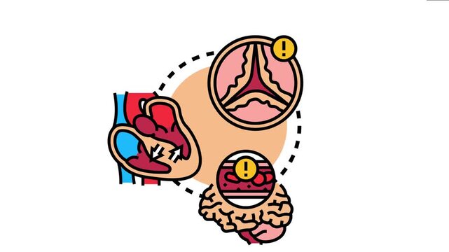 Human heart experiencing a circulation issue, forming a blood clot in the brain, and suffering from a dysfunctional cardiac valve, a serious health condition