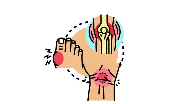 Osteoarthritis causing discomfort and inflammation in various joints, presenting icons of an affected elbow, a painful knee, and an aching foot due to the condition