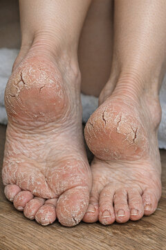 Dry, cracked heels on human feet. Skin shows signs of roughness and flaking. Feet rest on a wooden surface. Natural texture of skin is clearly visible. Details highlight common foot condition