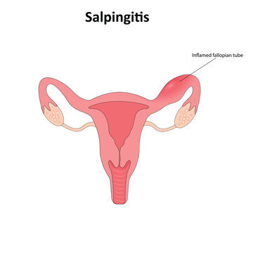 Salpingitis vector illustration