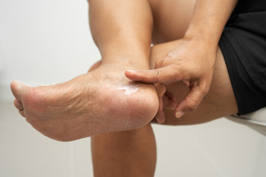 Asian woman check feet with crack and dry heel skin, Diabetic Foot.