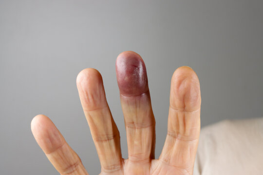 Man with a Badly Bruised Middle Finger 