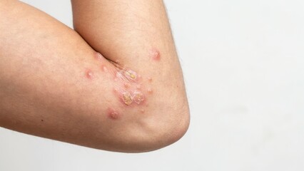 Fototapeta premium Close up of skin rash and blisters on human elbow isolated on white background