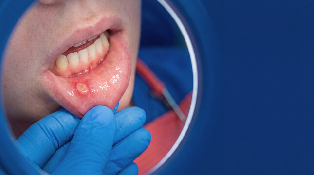 Aphthous ulcer on the inner lower lip of a patient during a dental examination