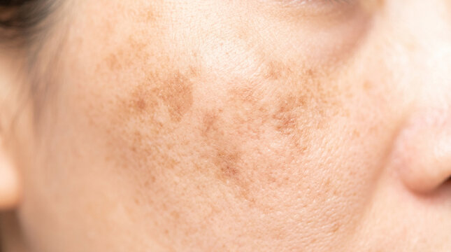 Melasma brown patches on cheek of a woman with light skin  