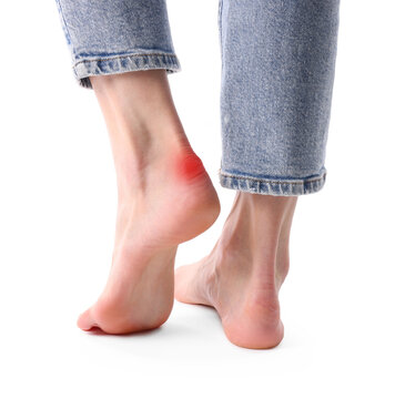 Woman with calluses on her foot against white background, closeup