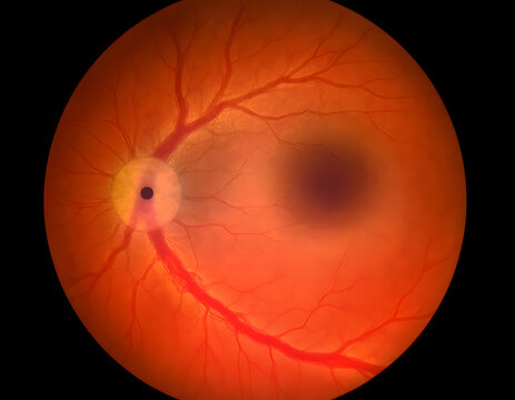 Fundus photography illustration showing human retina with optic disc and retinal blood vessels