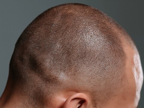Close-up side profile of a man's shaved head showing skin texture and contours