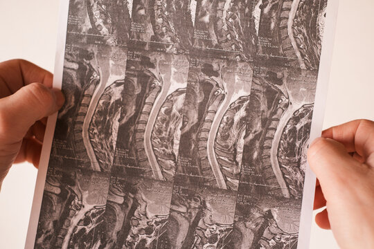 Medical MRI Spine Scan. X-rays of the spine in hand. Finger pointing to the spinal images. Back and spine health. Medical examination by a doctor..Hands Holding Medical MRI Scan Printout