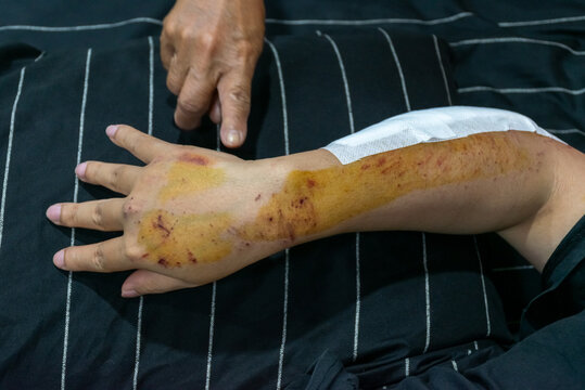 Close view of an injured arm hand bruises abrasions antiseptic stains wound dressing showing medical care after physical trauma