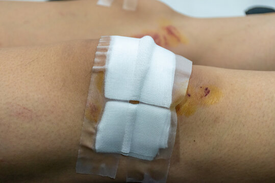 Close view of an injured knee covered sterile gauze medical tape visible bruising small wounds showing first aid care recovery after trauma
