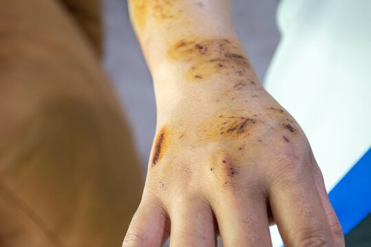 Close view of an injured hand wrist bruises abrasions scabs antiseptic stains showing healing skin after physical trauma