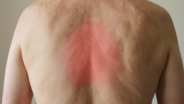 Close-up of Human Back with Skin Redness and Irritation Symptoms