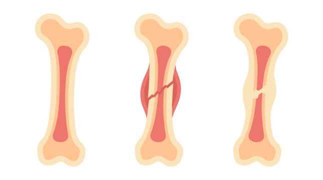 Medical illustration set of human bone health, healthy femur compared to broken bone fracture and healing callus, orthopedics study, surgery guide