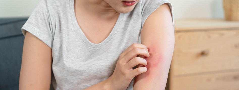 Sensitive skin allergic concept, Woman itching on her arm have a red rash from allergy symptom and from scratching