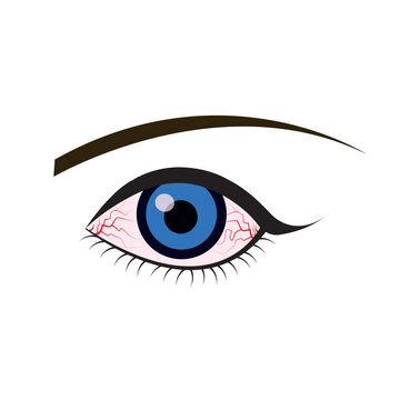Illustration of the eye disease. conjunctivitis