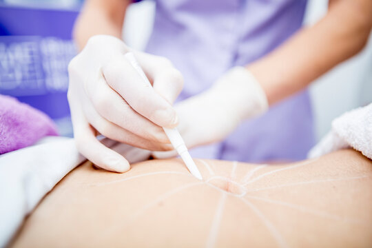 Aesthetic surgery, mesothreads, lifting