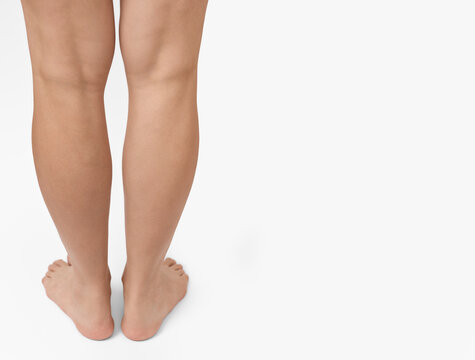 Rear view of female legs standing barefoot on a white background. Varicose veins disease treatment and flat feet diagnostics