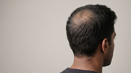 Fototapeta premium Ultra-Detailed Male Crown Hair Thinning Progression with Reduced Density, Natural Scalp Visibility and Clean Luxury Haircare Website Hero Composition.