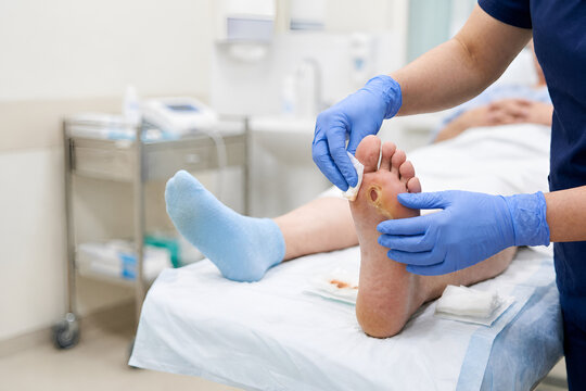 Healthcare professional treating diabetic foot ulcer on patient sole in hospital