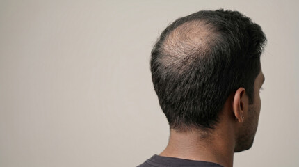 Fototapeta premium Advanced Progressive Crown Hair Loss on a Young Adult Man with Distinct Scalp Visibility and Sparse Remaining Hair in a Premium Medical Advertising Banner.
