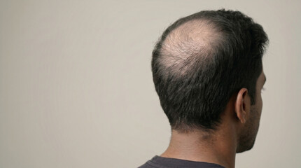 Fototapeta premium Photorealistic Advanced Crown Hair Thinning on a Young Adult Man with Enlarged Scalp Visibility and Reduced Hair Density for Premium Clinical Haircare Advertising.