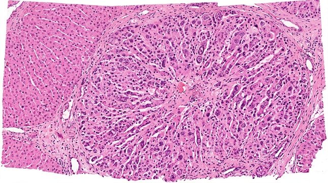 Microscopic View Of Hepatic Tissue Showing Cellular Abnormalities And Inflammatory Infiltration