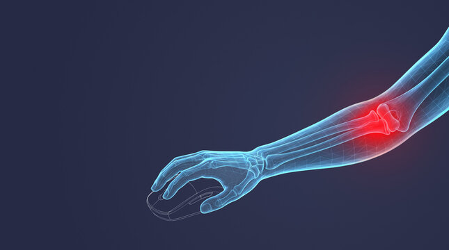 3D medical illustration of elbow joint pain while using a computer mouse