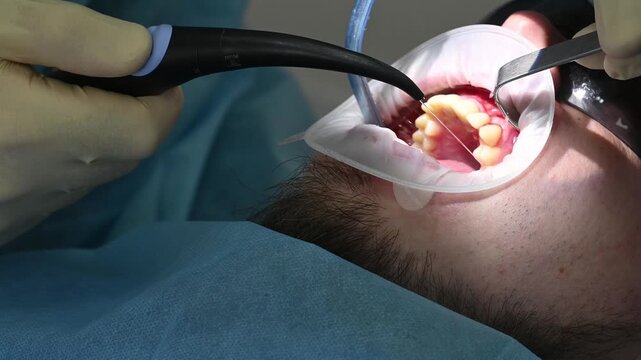 Close-up of dental caries treatment, drilling a tooth with a drill, and a saliva ejector. A doctor treats a male patient's tooth.