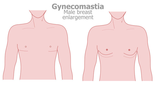 Gynecomastia is a benign, excessive growth of breast tissue in men. Male, man boobs. Illustration vector