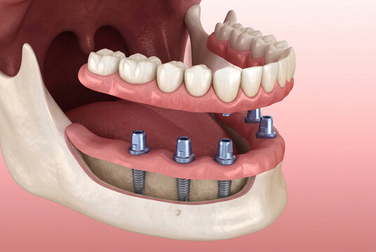 下顎に複数のインプラントを埋入しアバットメントで総義歯を固定する仕組みを示す３DCGイラスト、歯科治療の説明に使えるイメージ