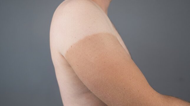 Male Shoulder and Upper Arm Showing Clear Distinct Sun Tan Line from T-Shirt