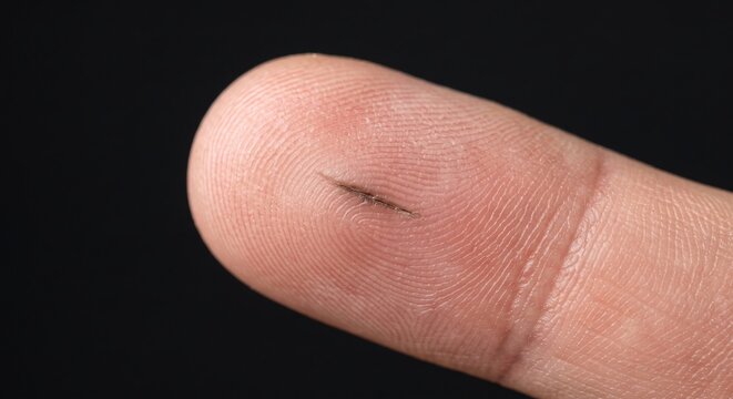 Macro View of Deep Wood Splinter Foreign Body Embedded Under Fingertip Skin