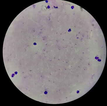 thick blood smear showing plasmodium falciparum malaria parasite under microscope 