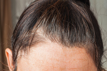 Fototapeta premium Close-up of thinning dark hair and receding hairline on a person's forehead