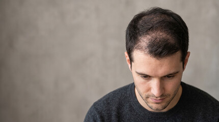 Fototapeta premium Noticeable Crown Hair Thinning on Young American Man with Natural Scalp Visibility, High-End Dermatology Advertising.