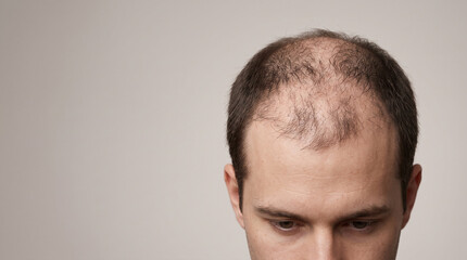 Fototapeta premium Ultra Realistic Young American Man Showing Advanced Severe Crown Hair Loss with Sparse Dark Hair and Visible Scalp.