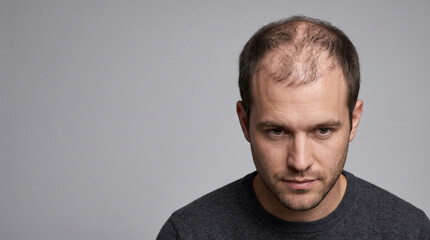 Naklejka premium Photorealistic Young American Male with Severe Hair Thinning and Extensive Scalp Exposure in Luxury Restoration Campaign.